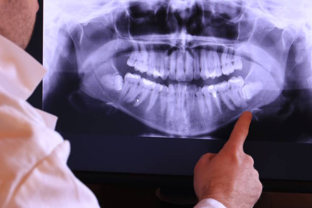 Best Emergency Root Canal Treatment in Pierceton, IN